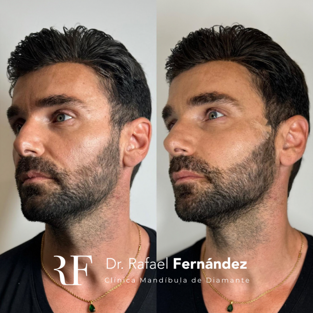 hilos tensores faciales